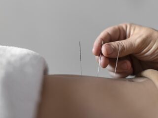 Perbedaan Dry Needling dan Akupuntur: Mana yang Lebih Efektif?