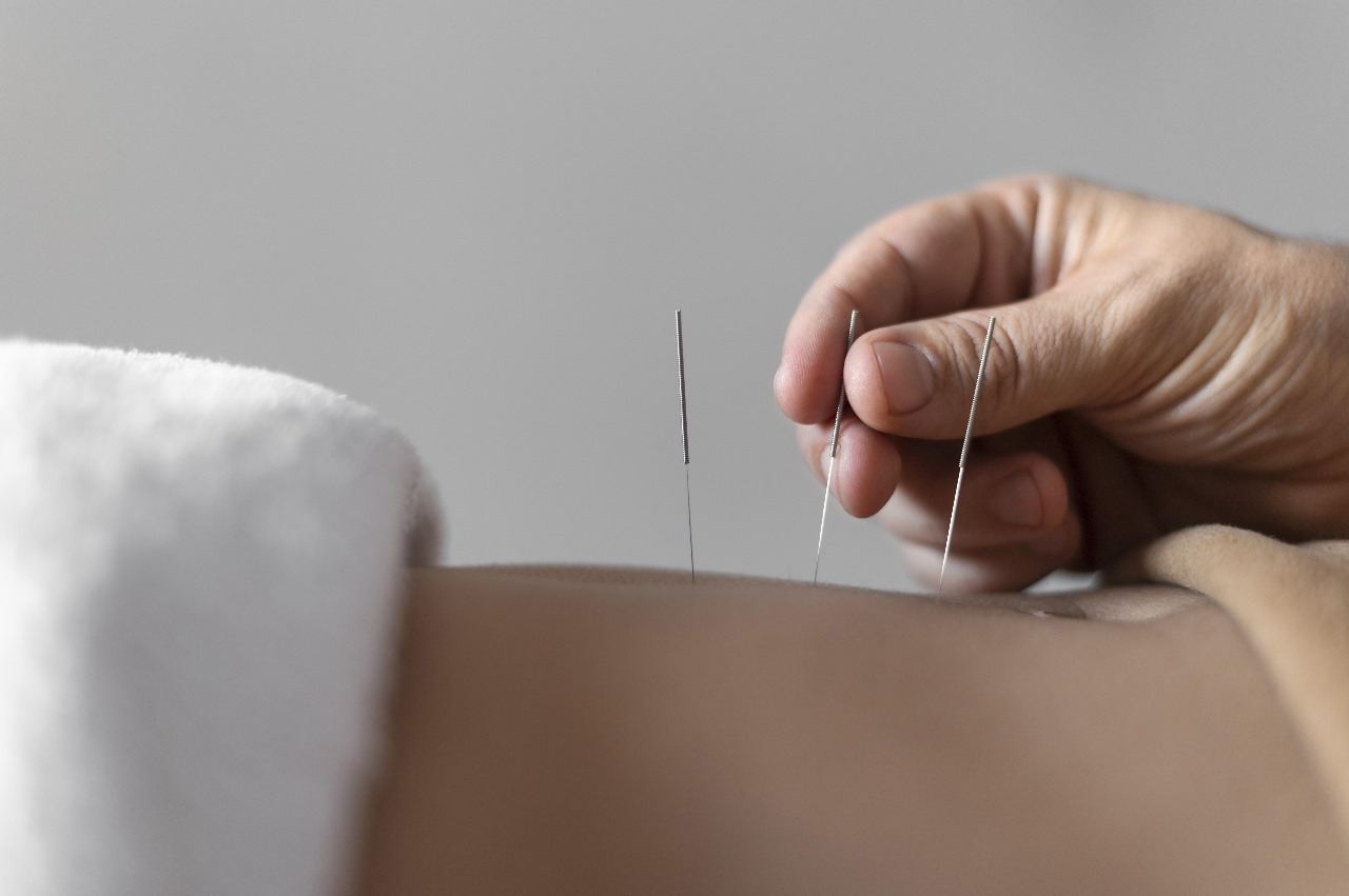 Temukan perbedaan mendasar antara dry needling dan akupuntur. Pelajari teknik, efektivitas, dan keamanan masing-masing metode