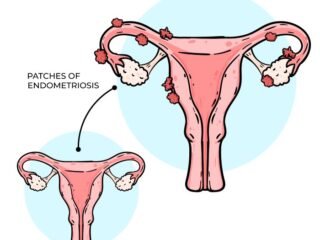endometriosis