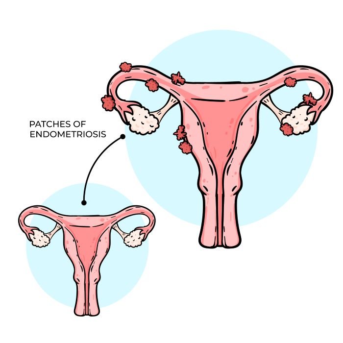 endometriosis