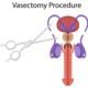 prosedur vasektomi