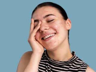 Rahasia Sembuh dari Jerawat Bertahun-tahun: Pengalaman Nyata yang Menginspirasi