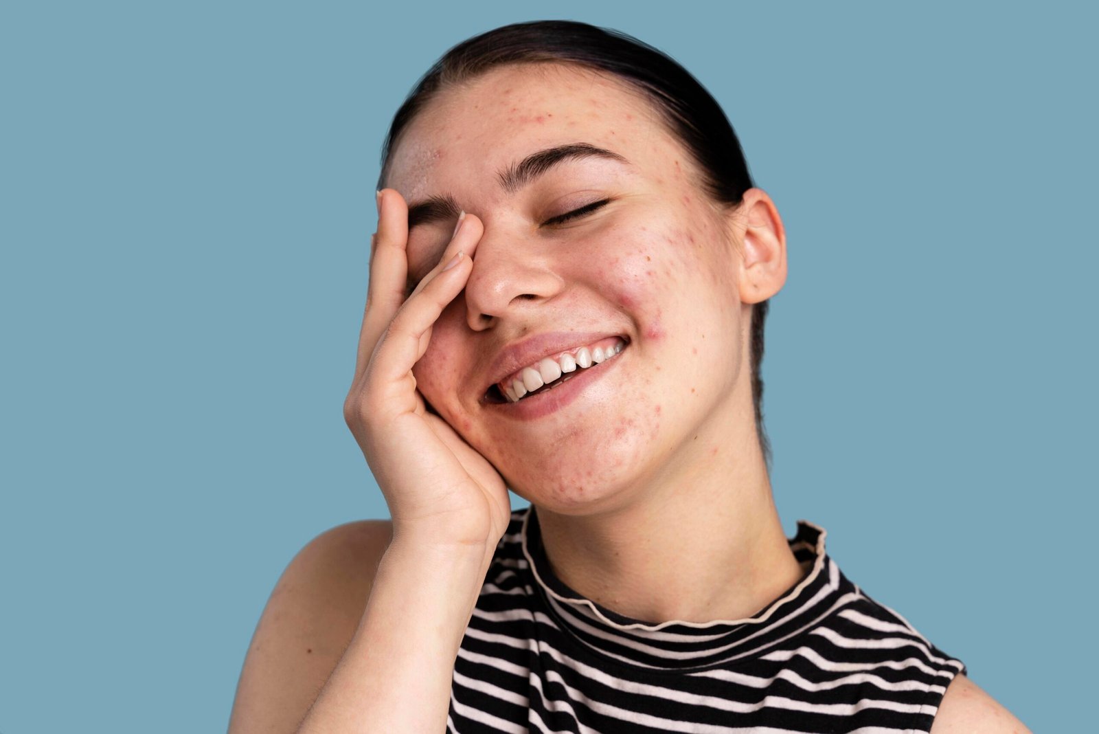 Kisah inspiratif sembuh dari jerawat bertahun-tahun dengan kebiasaan sehat dan produk perawatan yang benar.